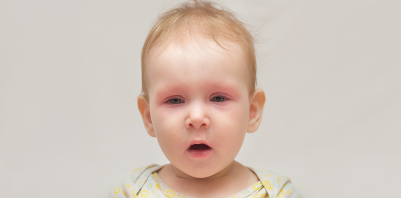 Atopic Dermatitis in Children in the Summer Months